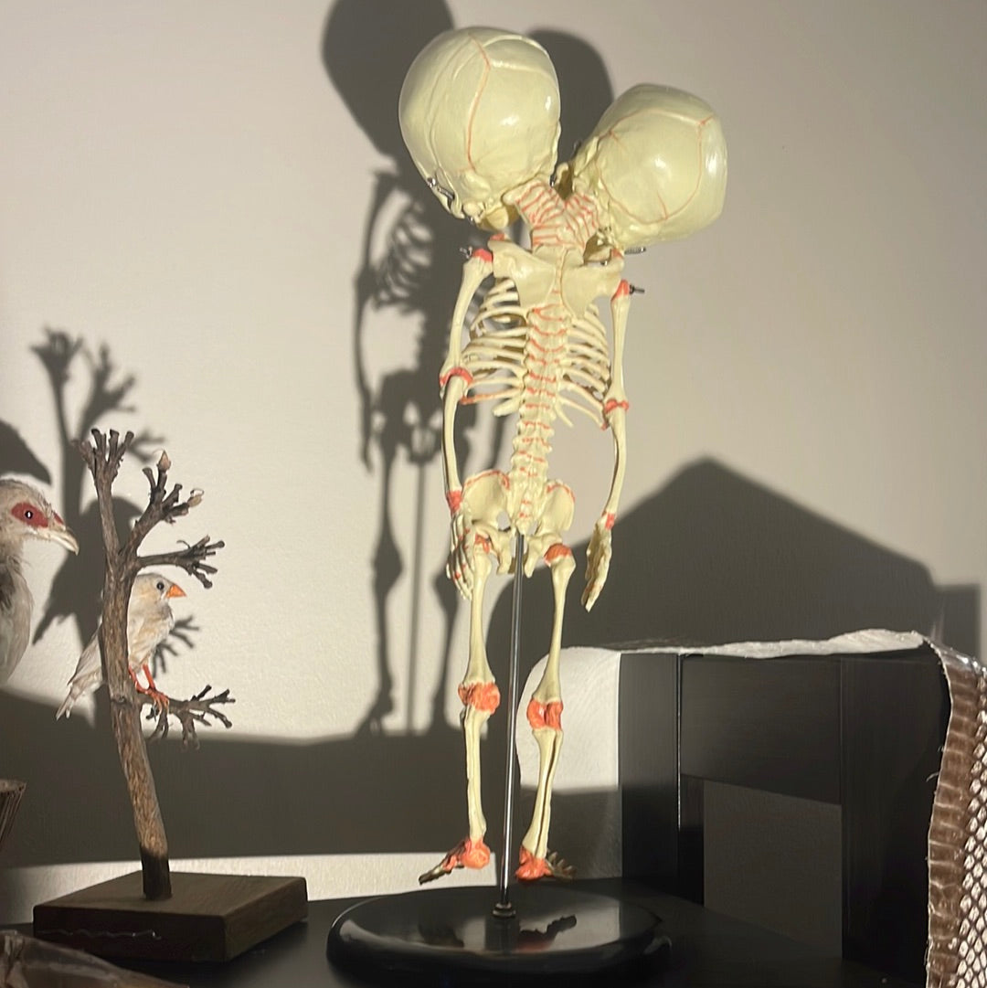 Conjoined Fetus Skeleton Display