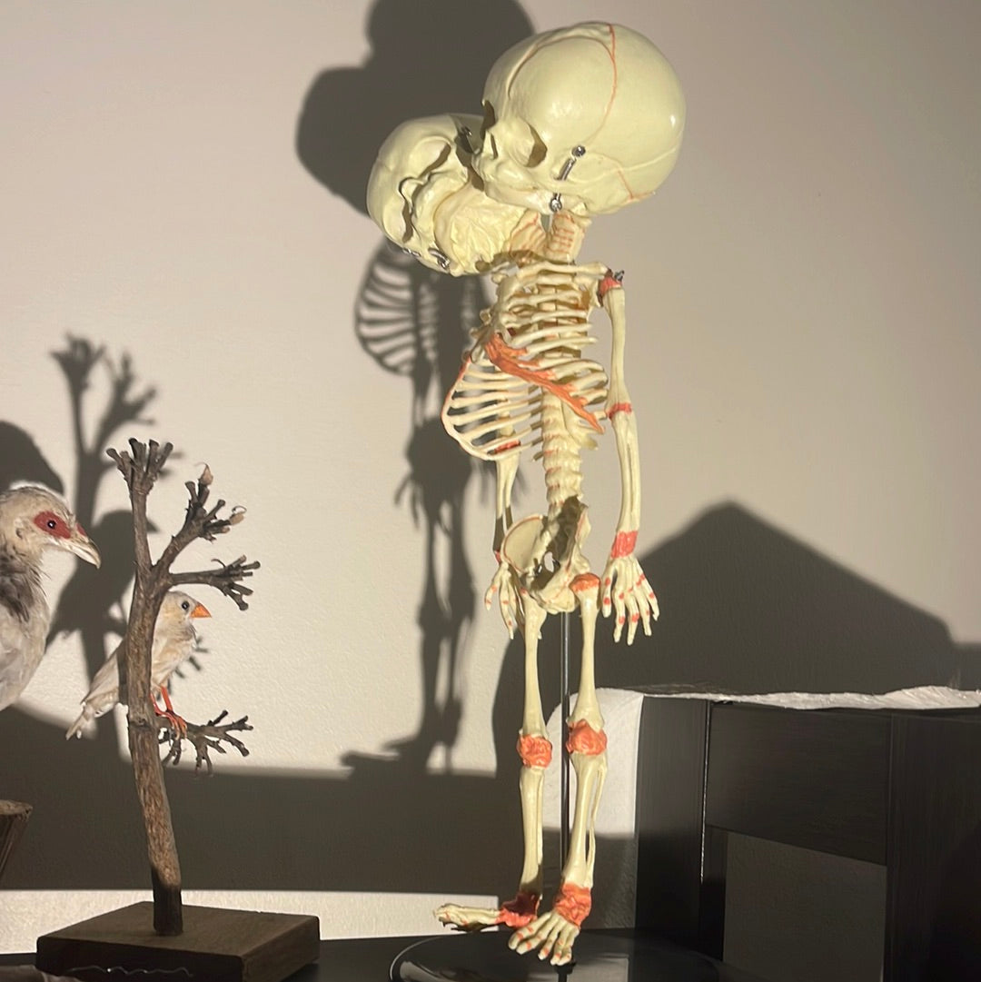 Conjoined Fetus Skeleton Display